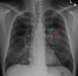 Doctor Shares 3 Ways to Lower Your Risk of Getting Lung Cancer
