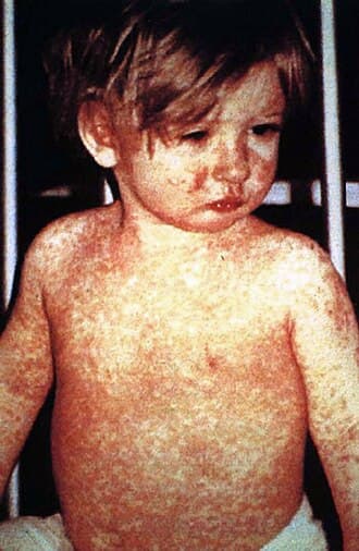 Measles surge dramatically in California among children and young adults - Los Angeles Times